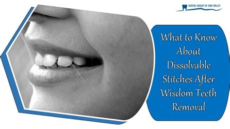 What To Know About Dissolvable Stitches After Wisdom Teeth Removal