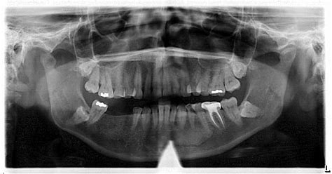 Diagnosis And Treatment For Breakthrough Clinical Oral Pathology Case