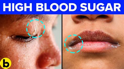 Your Blood Sugar Is High 9 Warning Signs To Look Out For Youtube