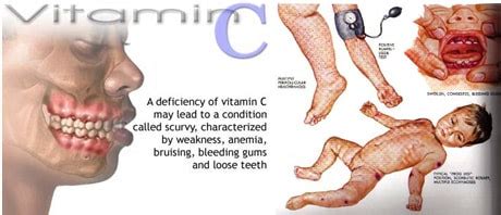 People who might be susceptible to vitamin c deficiency may benefit from the use of vitamin c supplements. D1: Human Nutrition (Core) - AMAZING WORLD OF SCIENCE WITH ...