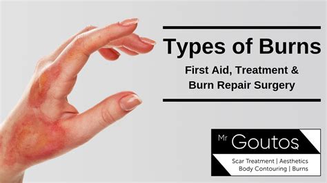 Types Of Burns First Aid Treatment And Burn Repair Surgery Youtube