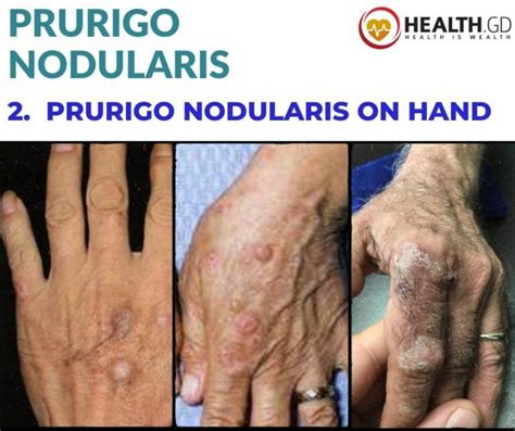 12 Pictures Of Prurigo Nodularis Diagnosis And Treatment Healthgd
