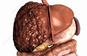 Liver cirrhosis - Stock Image - C008/3075 - Science Photo Library Cirrhosis  