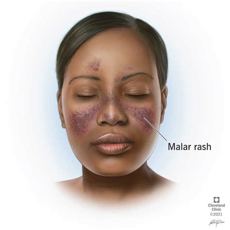Lupus Rash Types Causes Treatment And Prevention