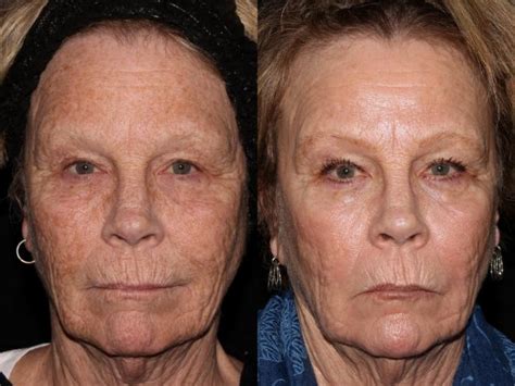 Profractional Laser Resurfacing Before And After Photo Gallery Chico Yuba City Oroville