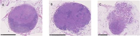 Microscopic View Of Lymph Node Metastases Without Ene A With