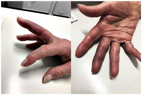 Achenbach Syndrome Paroxysmal Finger Hematoma Alejandro Godoy Aldo