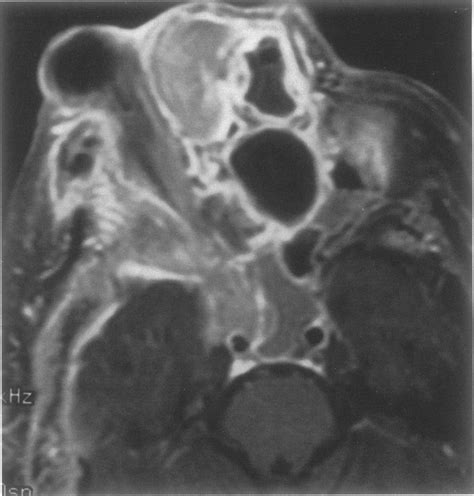 Axial Ti Weighted Fat Suppressed Post Contrast Mr Image Shows A Huge