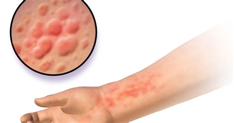 Skin Disorders And Infections Health Information