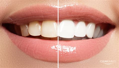 5 Simple Ways To Naturally Whiten Your Teeth Clear Smiles Dallas