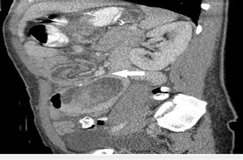 Abdominal Computed Tomography Ct Scan Sagittal View Showing