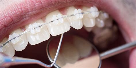 Veneers Or Braces Which One Gives The Most Effective Results