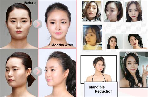 Before And After Plastic Surgery Korean