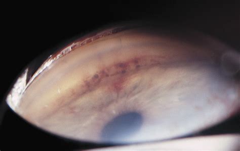 Malignant Melanoma Of The Conjunctiva With Intraocular Extension