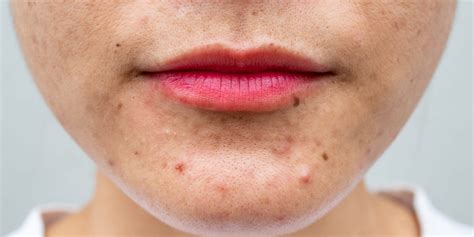 Dry Skin And Acne Causes And Treatments