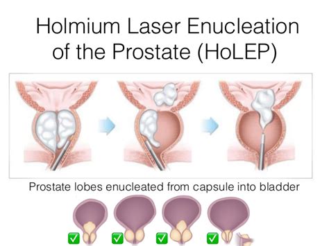 Treatment Of Bph Holep Prostate Matters