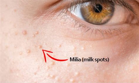 Milia On Face How To Get Rid Of Milia On Face At Home Easily