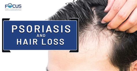 Psoriasis And Hair Loss Psoriasis Hair Loss Scalp Psoriasis Hair