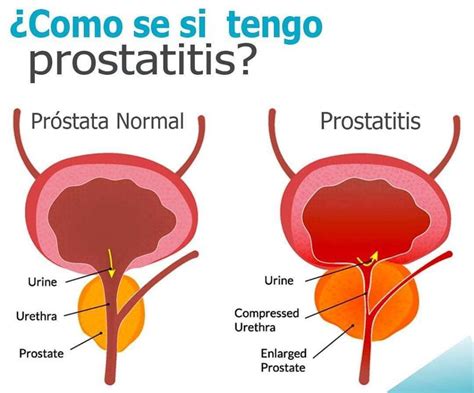 Prostatitis Síntomas ⊛ ¡prevención Y Tratamiento 2020