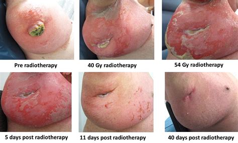 Get detailed information about the diagnosis and treatment of newly diagnosed and recurrent merkel cell carcinoma in merkel cell carcinoma: Cureus | Merkel Cell Carcinoma: When Does Size Matter for ...