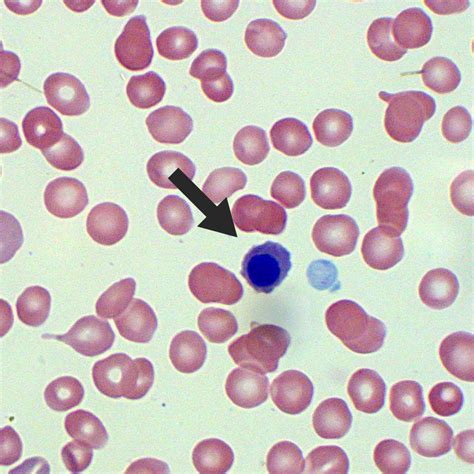 Nucleated Red Cells Blood Film Medschool