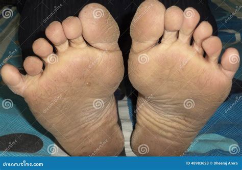 Six Fingers In Both Feet Stock Photo Image Of Rare Feet 48983628