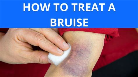 How To Treat A Bruise Youtube