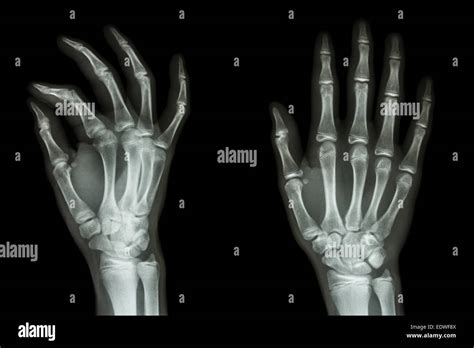 Film X Ray Hand Apoblique Show Normal Humans Hand Stock Photo