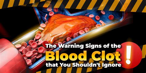 The Warning Signs Of The Blood Clot That You Shouldnt Ignoren