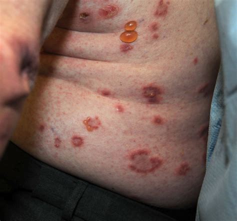 An 81 Year Old Man With A Blistering Rash The Bmj