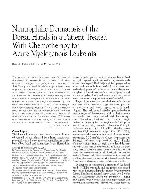 Neutrophilic Dermatosis Of The Dorsal Hands In A Patient Treated