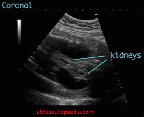 Perinephric Urinoma Ultrasoundpaedia