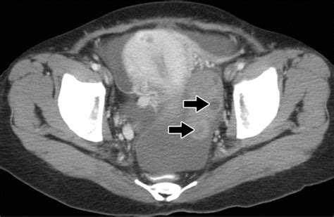 Case 210 Primary Ovarian Lymphoma 11c