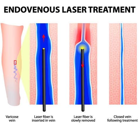 Varicose Vein Treatments Dermatology Laser And Vein