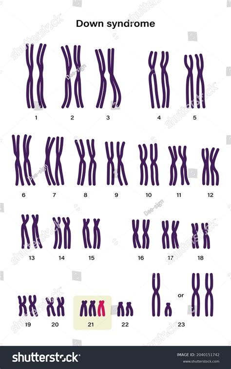 human karyotype down syndrome autosomal abnormalities stock vector royalty free 2040151742