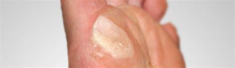Foot Pathologies Podiatric Diagnosis Cyprus