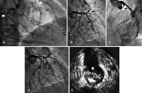 Coronary Angiography And Intravascular Ultrasound Image A Coronary