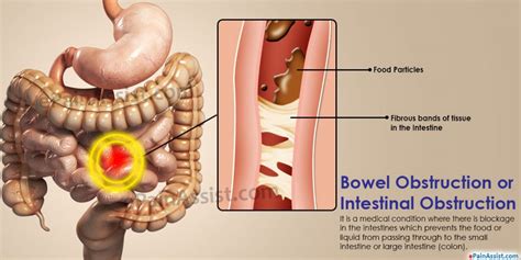 Causes Of Intestinal Obstruction