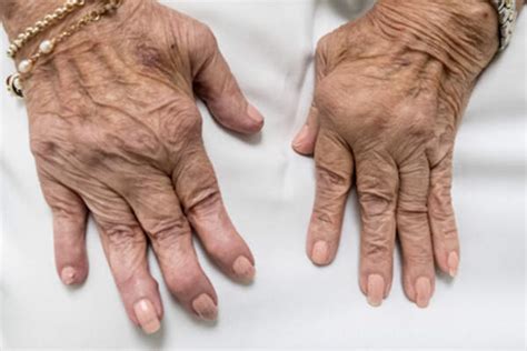 Rheumatoid Arthritis Signs To Watch For Healthcentral