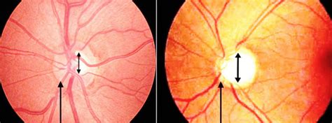 Left Non Infected And Right Glaucoma Infected Fundus Image From