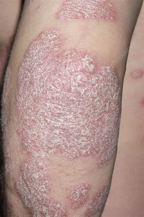 Chronic Plaque Psoriasis On Arm Stock Image M2400767 Science