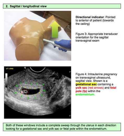 Pdf Transvaginal Ultrasound During Pregnancy Perception And Hot Sex Picture