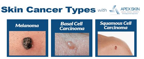 Major Types Of Skin Cancer