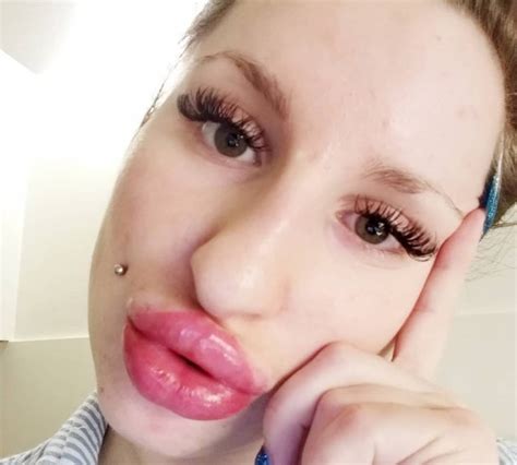 Woman Obsessed With Having Huge Lips Spends Thousands On Filler Metro
