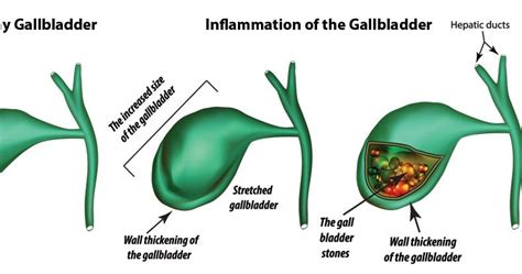How To Test The Gallbladder Diagnosis Of Gallstones Niddk