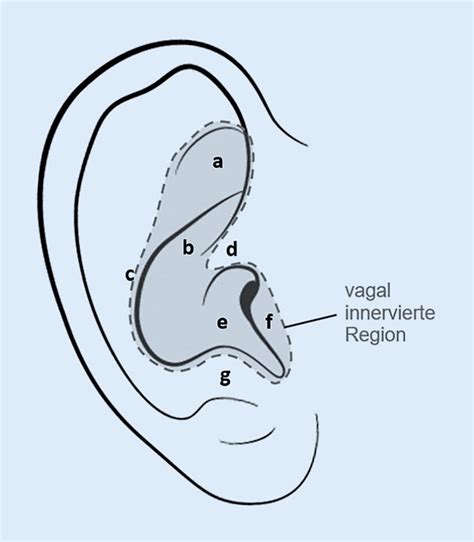 Abb 1 8 Ohranatomie Mit Eingezeichnetem Vagal Innervierten Bereich Und