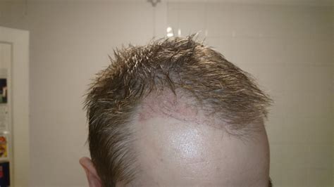 6 Weeks Post Hair Transplant Brownploaty