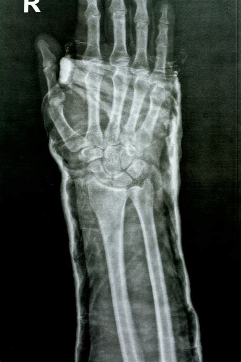 Plain X Ray Right Wrist Joint Shows Right Distal Radius Fracture