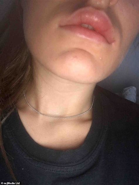 Woman 21 Reveals She Was Left With Concrete Lips After Paying £120