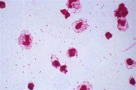 Streptococcus Pneumoniae Gram Stain Csf